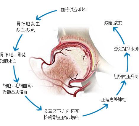 股骨头缺血后的病理变化.jpg